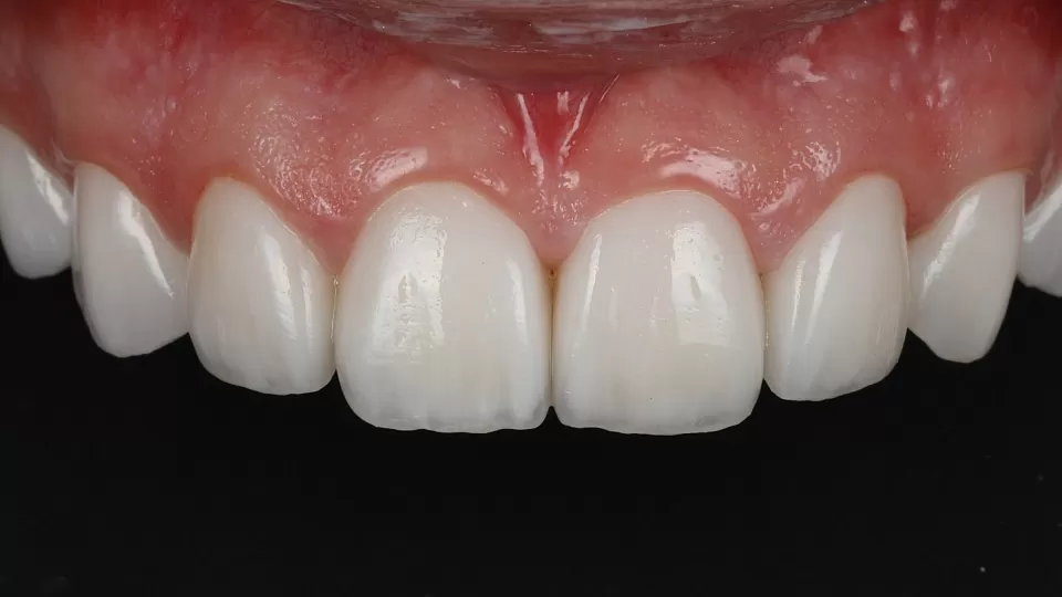 Цельнокерамические коронки на передние зубы при флюорозе